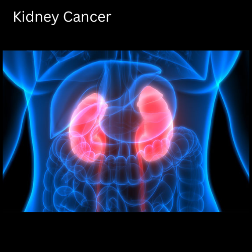 Kidney Cancer