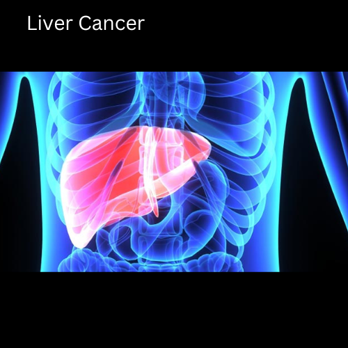 Liver Cancer