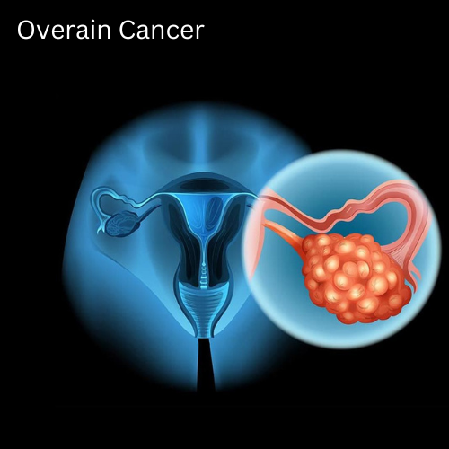 Ovarian Cancer