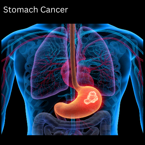 Stomach Cancer